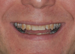 Figure 1 Initial presentation of the patient showing a low lip line smile.