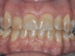 Figure 2 Clinical buccal view of tooth No. 7.