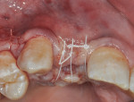 Figure 8 Tension-free closure after a buccal periosteal-releasing incision with high density PTFE and 6-0 plain gut sutures, which also closed the vertical-releasing incision at tooth No. 6 distally.