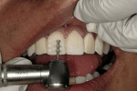 Figure 4  The preparation procedure for the veneers consisted of making 0.5-mm depth cuts into the provisionals.