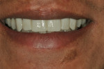 Figure 5  Close-up of the patient’s smile with the provisionals in place.