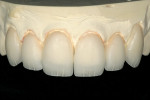 Figure 11  High- and low-value internal stain effects were added to the restorations to create an esthetically pleasing result. Gray stain was also added to the mesio-incisal and disto-incisal troughs for even more esthetic value.
