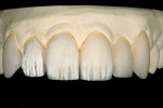Figure 12  IPS e.max Light MM powder was then used, with a single segment of Salmon MM in the middle lobe, to make up the internal mamelons. White dentin powder was then feathered over the ends of the mamelons and into the middle cervical.