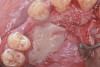Figure 11  Retracted teeth showing restoration of peg laterals.