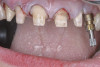 Figure 12  Restorative preparations gaining access and removing caries..