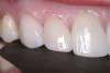 Figure 16  Final composite restoration following extensive layering to avoid the negative effects of shrinkage.