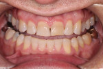 Pretreatment retracted photograph with teeth apart displaying the wear on the maxillary and mandibular anterior teeth.