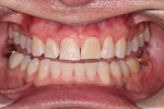 At the first appointment, the deteriorated composite on tooth No. 9 was removed, and the rest of the maxillary teeth were roughened with a fine grit diamond finishing bur prior to bonding.