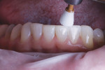 Finally, the occlusion was checked, and the teeth were polished with a cup (Enhance® Dentsply Sirona).