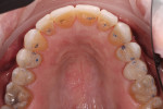 Maxillary occlusal view demonstrating the establishment of stable centric stops.