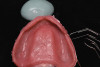 Figure 12  Preoperative mounted casts, complete maxillary extraction/immediate placement/immediate load patient.