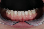 Figure  8   Lower incisors at the completion of Invisalign<sup>®</sup> treatment 16 weeks, notice the tipping of teeth Nos. 24 and 25. This would be corrected in the following weeks using conventional brackets (see Fig 10)