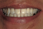 Figure 2  Preoperative close-up of the patient’s smile.