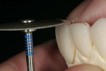 Figure 9  Utilizing a center diamond disc, an undercut was made to guarantee a halo at the end of the process.