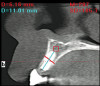 Figure 2.Tooth preparation following amalgam and decay removal and bonding.
