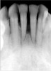 Figure 7. Three defective amalgams and cracks on the first molar and bicuspids.