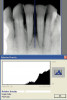 Figure 9. Prepared teeth after removal of decay and cracks.