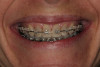 Figure 15 An ovate pontic supports the facial gingival margin and allows the prosthetic replacement to appear, as would a natural tooth, to emerge from the gingiva.