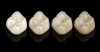Figure 14a  Zirconia crown on tooth No. 9.